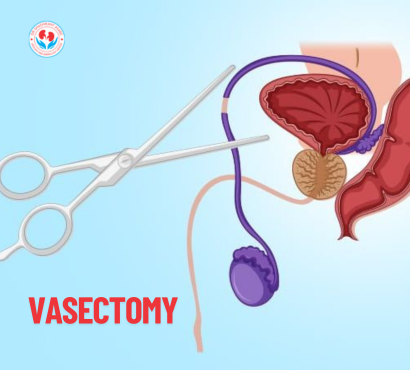Vasectomy: What to Expect Before, During, and After the Procedure